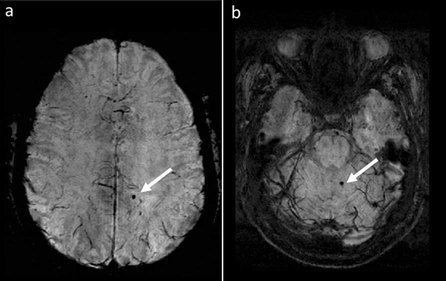 Study: Cerebral microbleeds in MS patients are associated with Increased Risk for Physical and Cognitive disabilities. Image